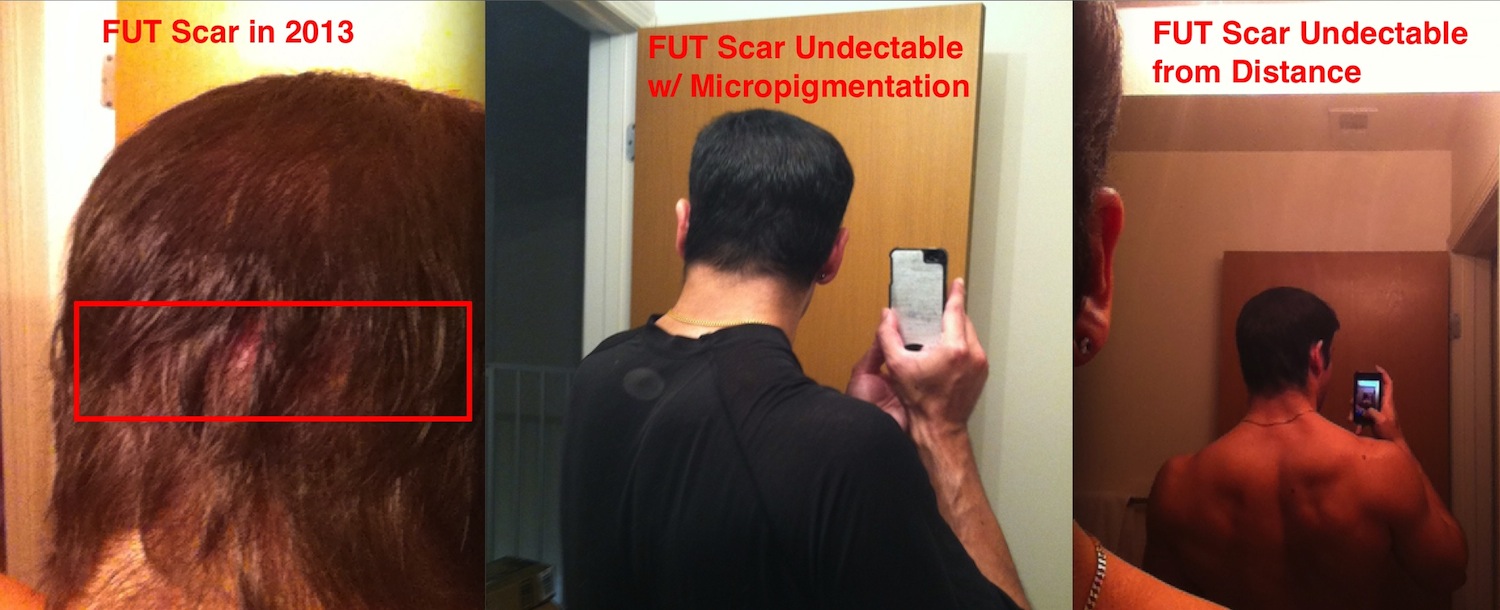 Chris FUT Hair Transplant Scar 2014 JPG