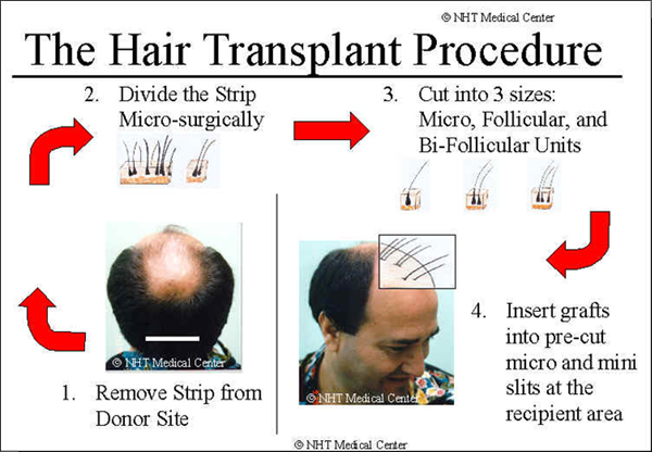 how hair transplants work