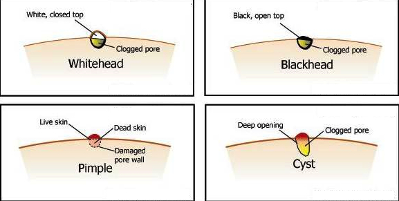 skin whitehead blackhead acne cyst