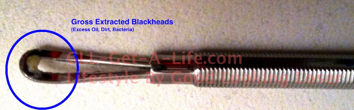 blackheads removed watermarked